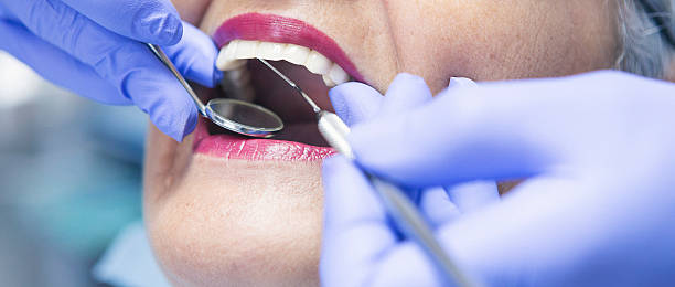 Best Emergency Wisdom Teeth Removal in Polo, IL